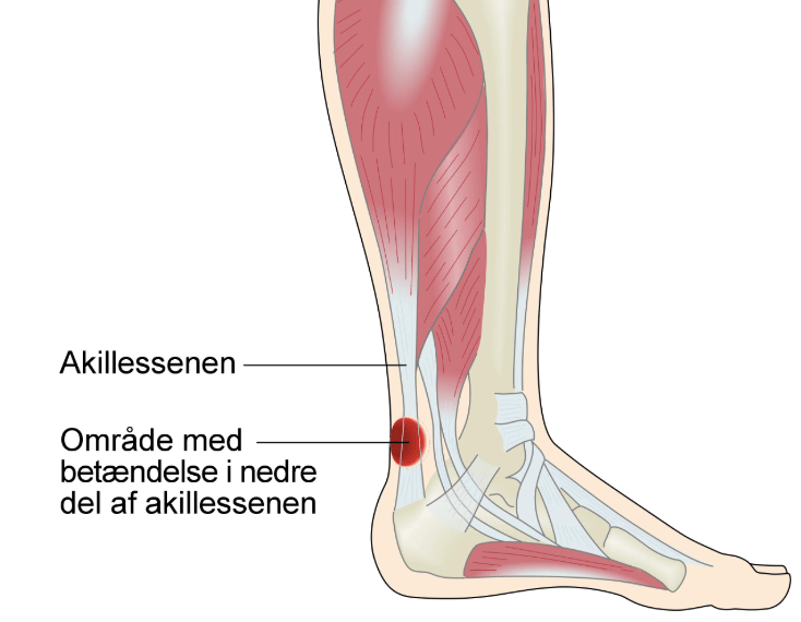 Akillessenebetændelse