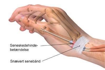 Seneskedehindebetændelse